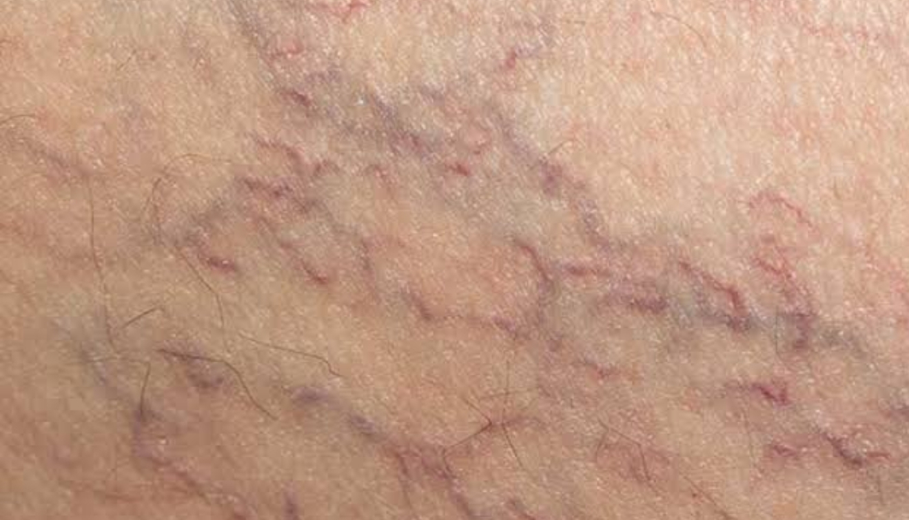 Veins and Vascular Lesions Sydney Cosmetic Specialists